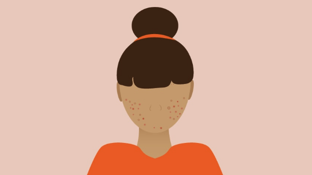 Comment les dermatologues traitent l’acné: 5 options expliquées